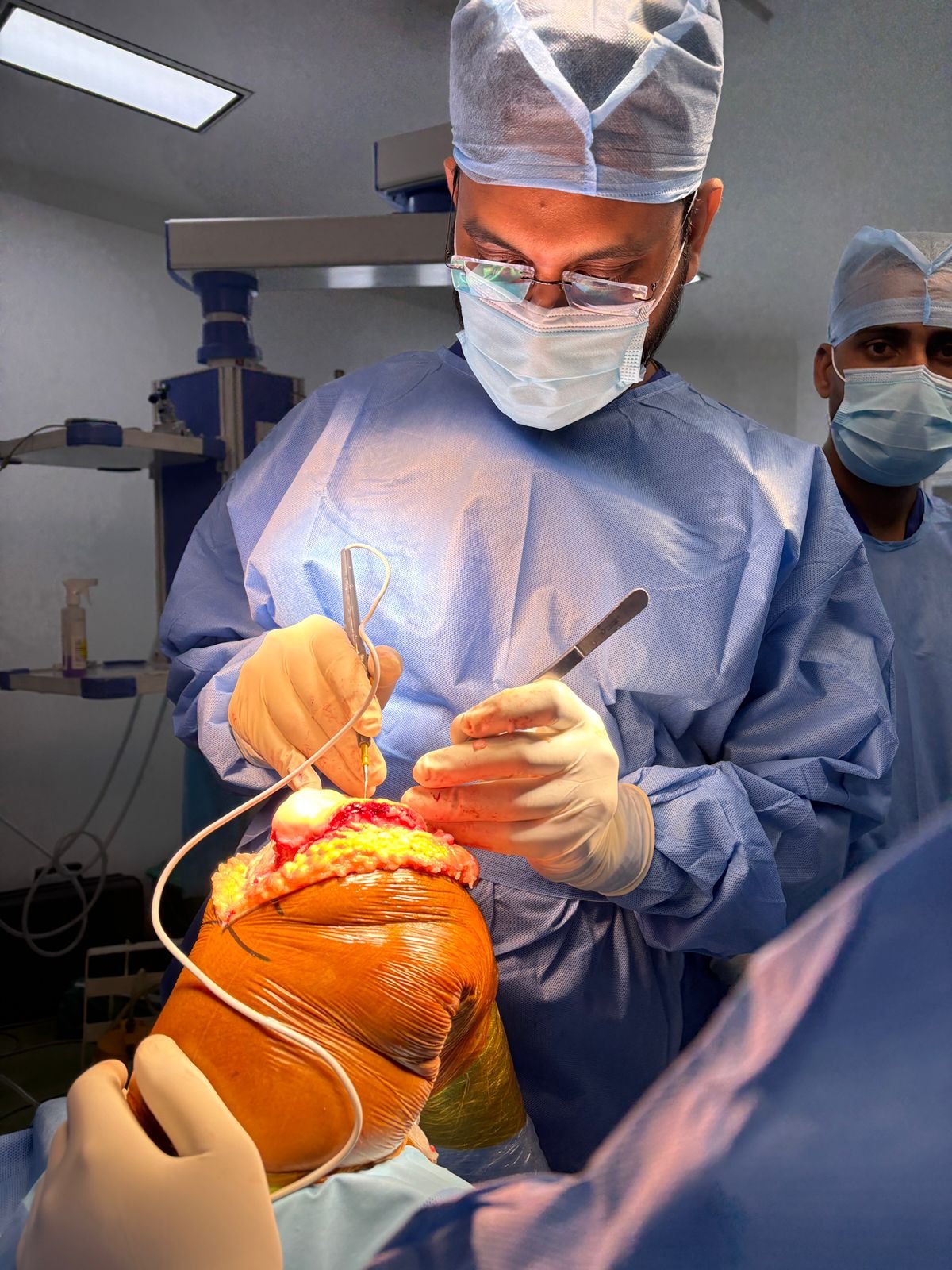 Intra‑operative knee replacement